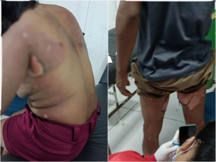 Mulher e filho sofrem queimaduras graves após tentativa de feminicídio na zona rural de Parintins